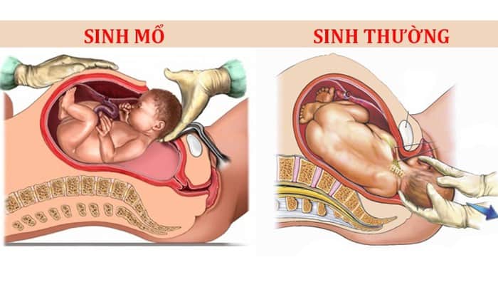 Kinh Nghiệm Sinh Con Lần Đầu Từ Khi Mang Thai Đến Sau Khi Lâm Bồn