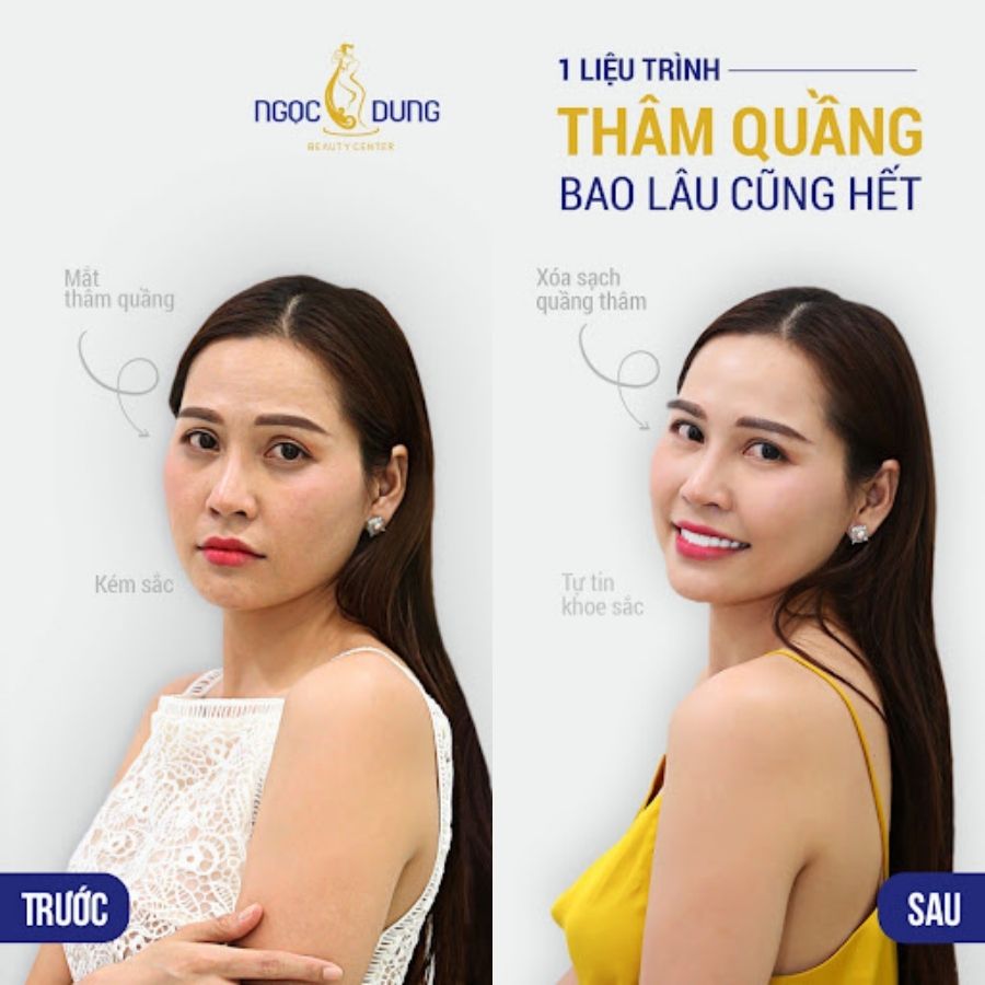 Khách hàng - Chị Mộng Thu sau liệu trình điều trị thâm quầng mắt, với đôi mắt trẻ trung tươi sáng