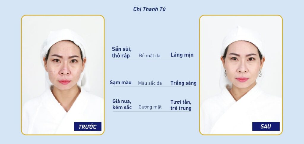 Ưu điểm và hiệu quả mà công nghệ Fractional Plus mang lại.